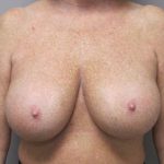 Breast Reduction Before & After Patient #1719