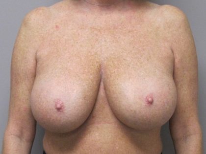 Breast Reduction Before & After Patient #1719