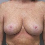 Breast Reduction Before & After Patient #1719