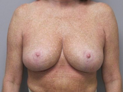 Breast Reduction Before & After Patient #1719