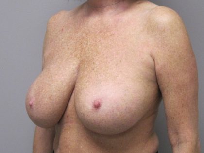 Breast Reduction Before & After Patient #1719