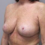 Breast Reduction Before & After Patient #1719