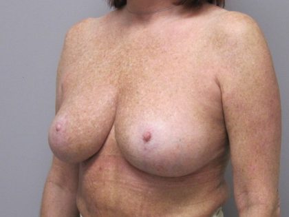 Breast Reduction Before & After Patient #1719