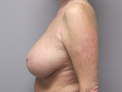 Breast Reduction Before & After Patient #1719