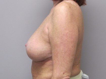 Breast Reduction Before & After Patient #1719