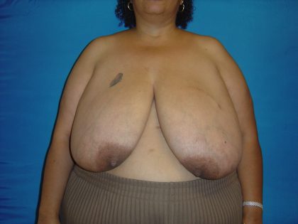 Breast Reduction Before & After Patient #1737