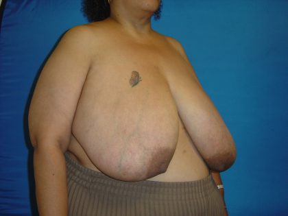 Breast Reduction Before & After Patient #1737