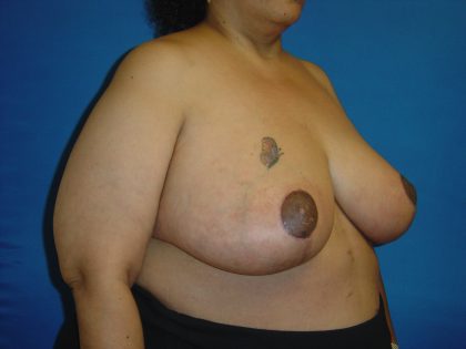 Breast Reduction Before & After Patient #1737