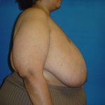 Breast Reduction Before & After Patient #1737