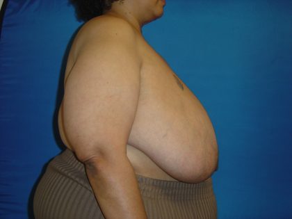 Breast Reduction Before & After Patient #1737