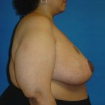 Breast Reduction Before & After Patient #1737