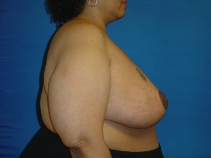 Breast Reduction Before & After Patient #1737