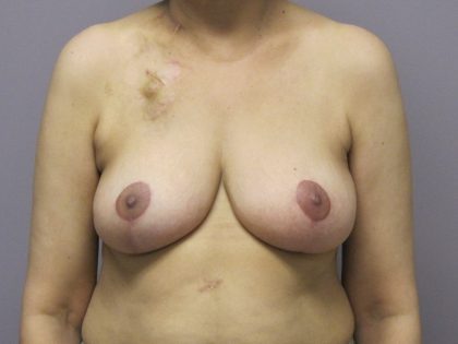 Breast Reduction Before & After Patient #1718