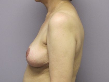 Breast Reduction Before & After Patient #1718