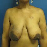 Breast Reduction Before & After Patient #1716