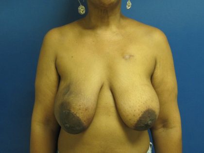 Breast Reduction Before & After Patient #1716