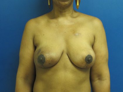 Breast Reduction Before & After Patient #1716