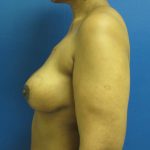 Breast Reduction Before & After Patient #1716