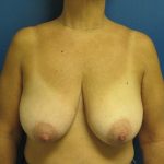 Breast Reduction Before & After Patient #1715