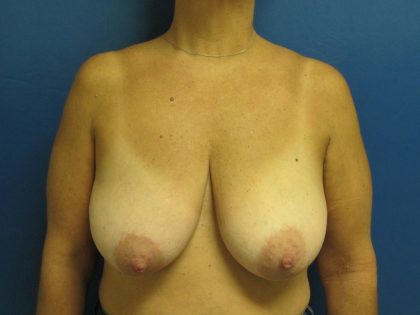 Breast Reduction Before & After Patient #1715