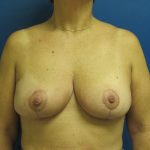 Breast Reduction Before & After Patient #1715