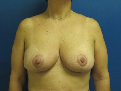 Breast Reduction Before & After Patient #1715