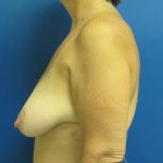 Breast Reduction Before & After Patient #1715