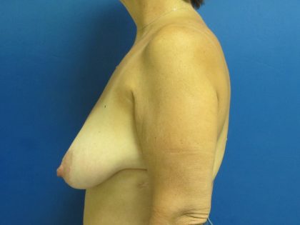 Breast Reduction Before & After Patient #1715