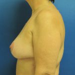 Breast Reduction Before & After Patient #1715