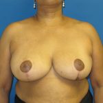 Breast Reduction Before & After Patient #1736