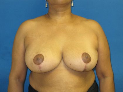 Breast Reduction Before & After Patient #1736