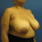 Breast Reduction Before & After Patient #1736