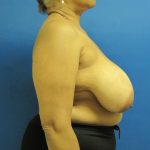 Breast Reduction Before & After Patient #1736