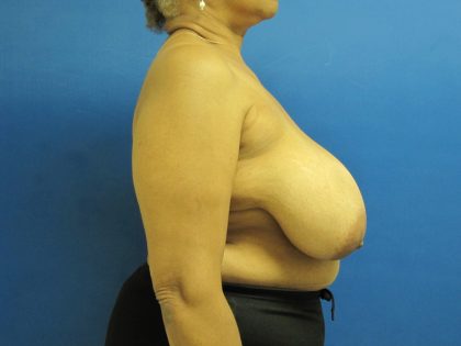 Breast Reduction Before & After Patient #1736