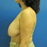 Breast Reduction Before & After Patient #1735