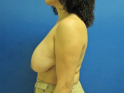 Breast Reduction Before & After Patient #1735