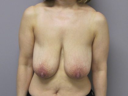 Breast Reduction Before & After Patient #1734