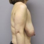 Breast Reduction Before & After Patient #1734