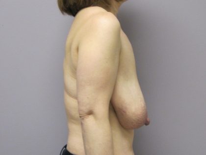 Breast Reduction Before & After Patient #1734