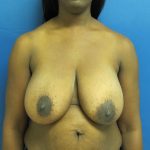 Breast Reduction Before & After Patient #1732