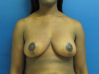 Breast Reduction Before & After Patient #1732