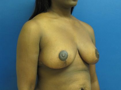 Breast Reduction Before & After Patient #1732