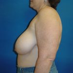 Breast Reduction Before & After Patient #1731