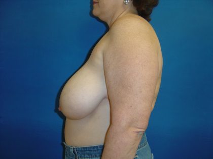 Breast Reduction Before & After Patient #1731