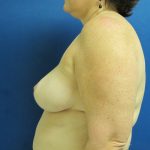 Breast Reduction Before & After Patient #1731