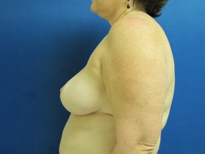 Breast Reduction Before & After Patient #1731