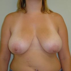 Breast Reduction Before & After Patient #1730