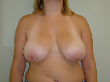 Breast Reduction Before & After Patient #1730