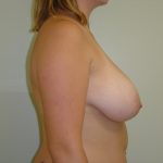 Breast Reduction Before & After Patient #1730