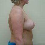 Breast Reduction Before & After Patient #1730